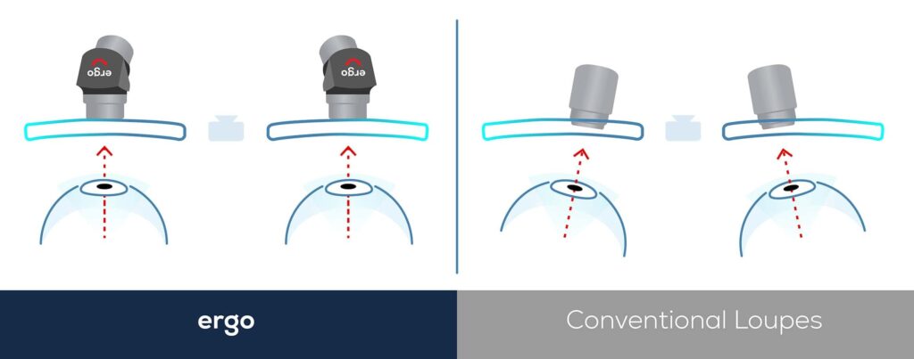 ergo-loupes-vs-galilean-conventional-loupes